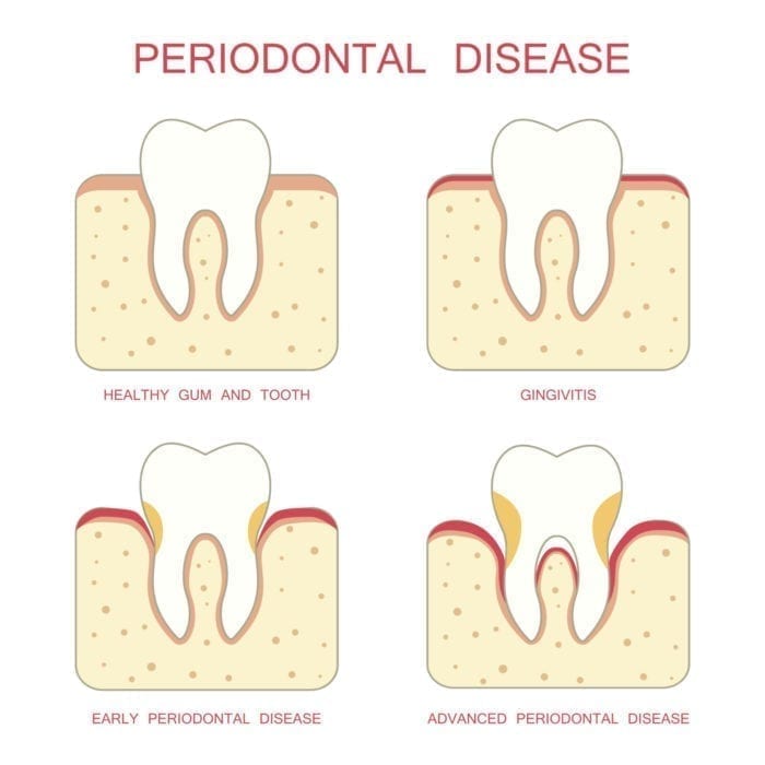 stages of gum disease chapel hill nc