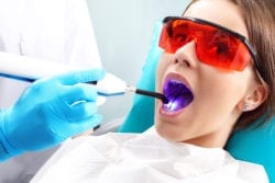 dental fillings
