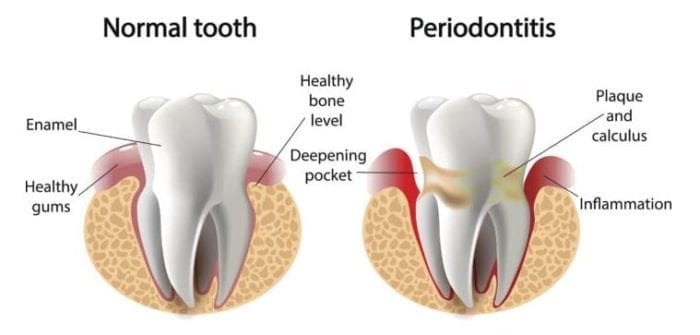 gum disease