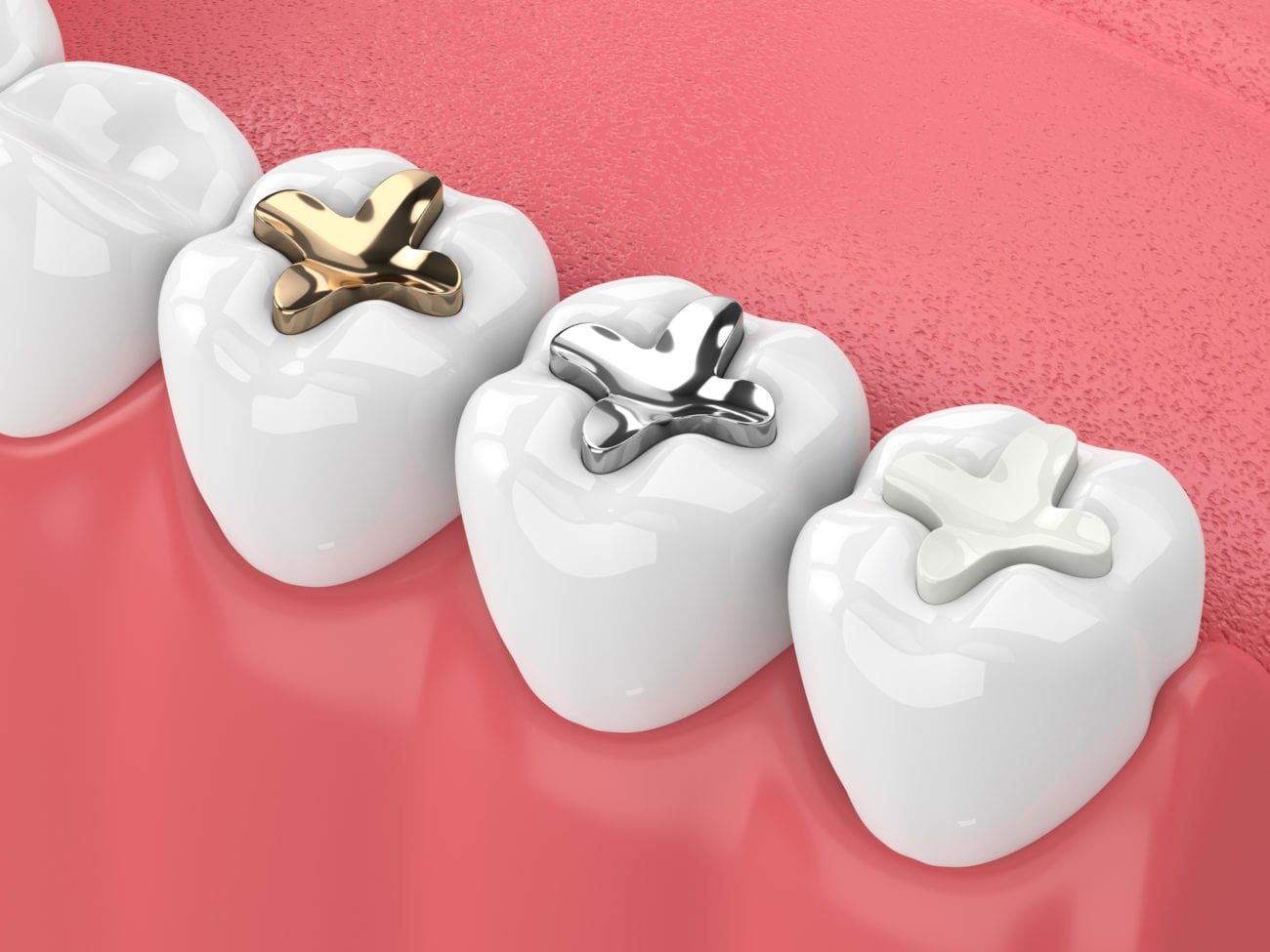 What is a Tooth Filling? White Tooth Fillings are Healthy and Durable