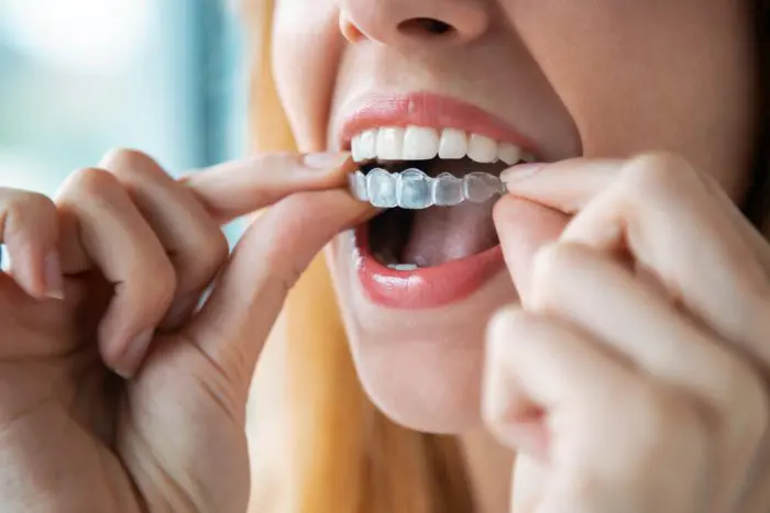 SureSmile Aligners in Chapel Hill, North Carolina