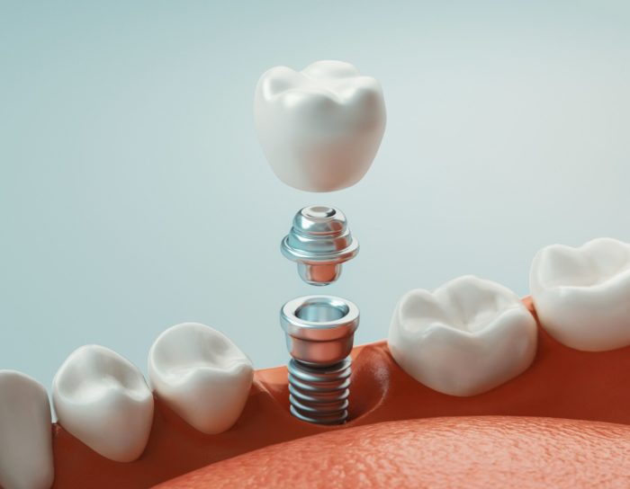 3D render of dental implant - post, abutment, and crown restorative dentistry dentist in Chapel Hill North Carolina