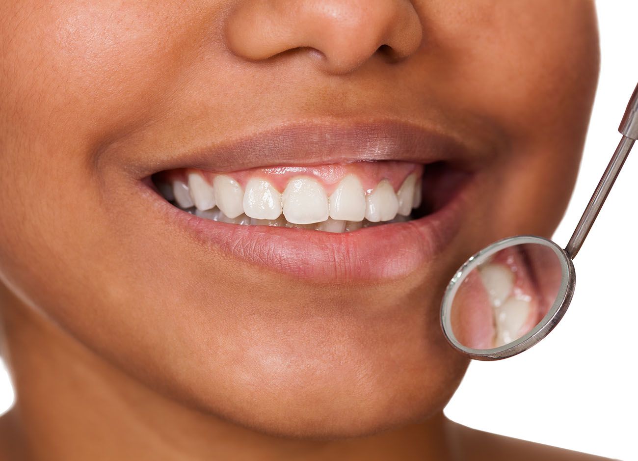 close up cropped image of woman smiling with a dental mirror near her mouth white spots dental concern oral health dentist in Chapel Hill North Carolina