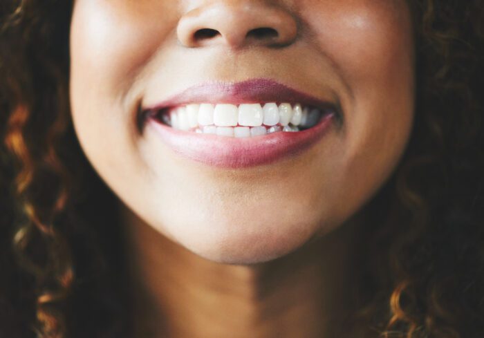 TOOTH BONDING in Chapel Hill, NC can help reshape your teeth and improve your smile.