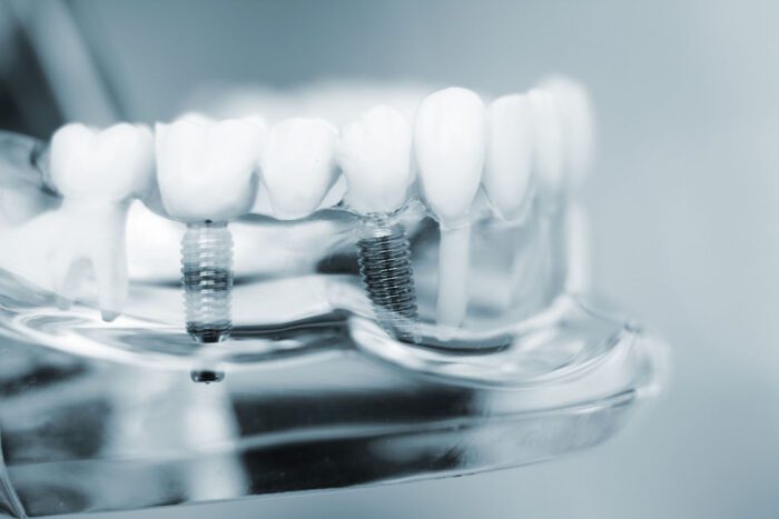 Dental Implants in Chapel Hill, NC, can help restore your bite after losing a tooth