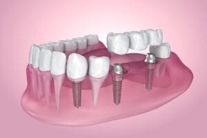 Missing Teeth in Chapel Hill NC could lead to damage without treatment