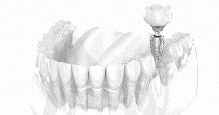 Dental Implant Model