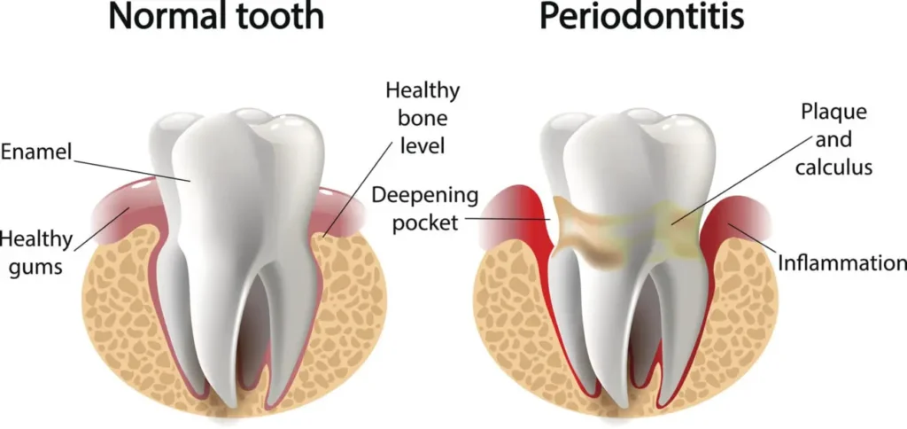 Dentist for periodontal therapy in Chapel Hill NC