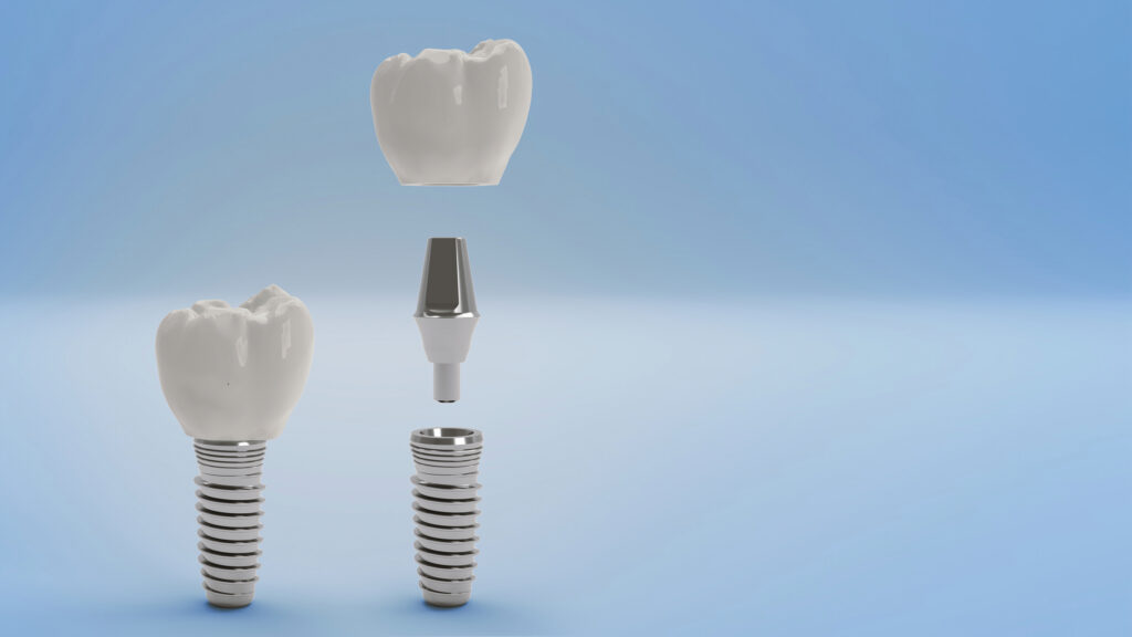 Tooth Implant Chapel Hill NC