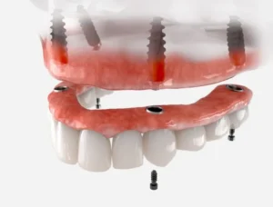 Dentures or Implants? Which to Choose? in Chapel Hill, NC